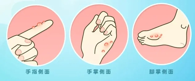 脚上怎样分辨是湿疹还是脚气(脚上怎么分辨是湿疹还是疱疹) 脚上怎样分辨是湿疹还是脚气(脚上怎么分辨是湿疹还是疱疹)
